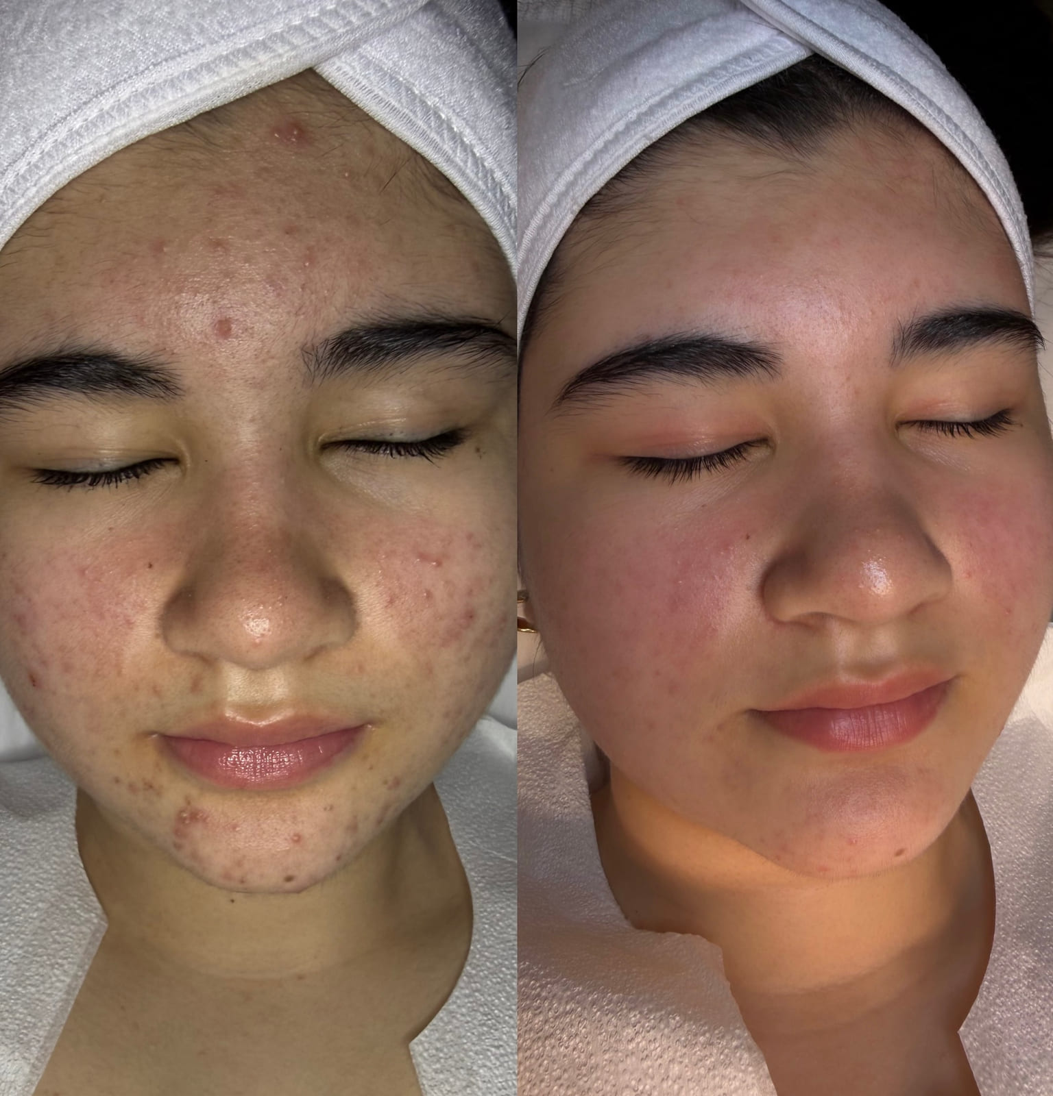 Acne Treatment (Face Reality)