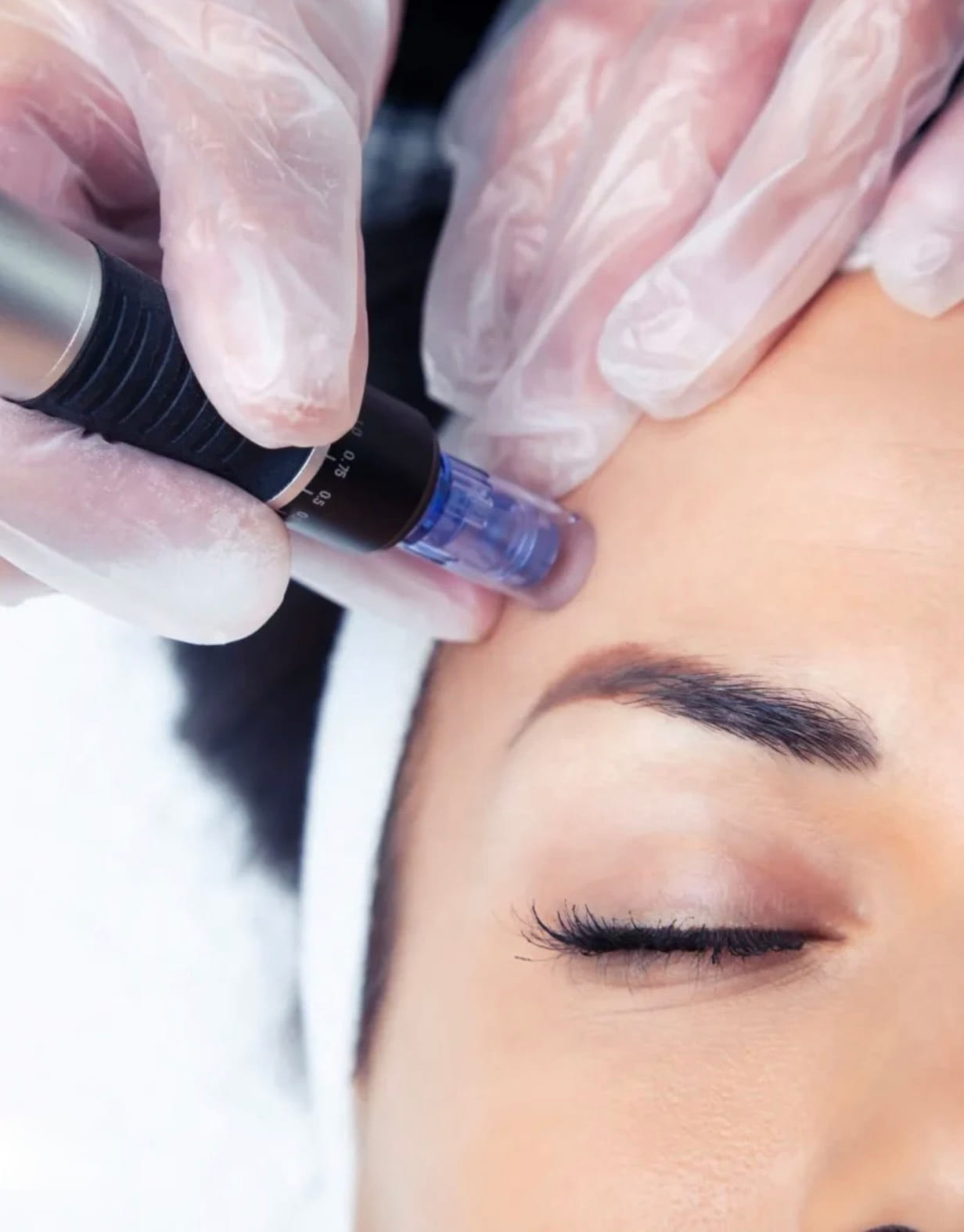 Microneedling